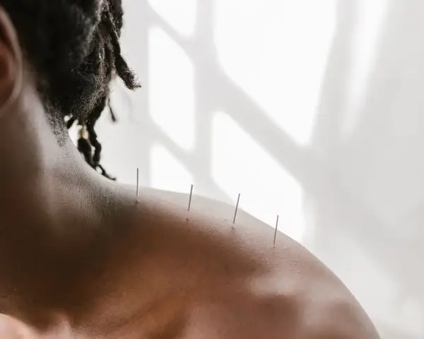 Fine acupuncture needles resting along the top of a man's shoulder in a bright white room